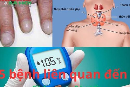 Danh sách 5 bệnh liên quan đến rối loạn nội tiết