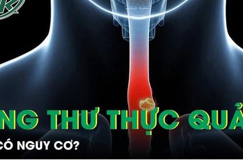 Ai có nguy cơ ung thư thực quản?