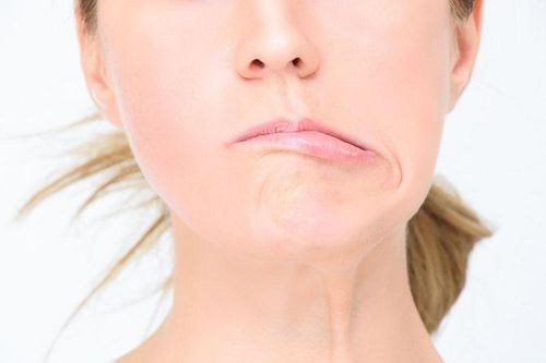 Méo miệng vì dây thần kinh số 7