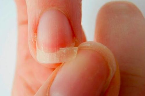 Móng tay bỗng nổi đốm trắng, sần sùi, dễ gãy cảnh báo bất ổn sức khỏe gì?
