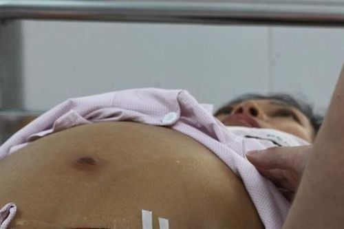 Người phụ nữ mắc xơ gan giai đoạn cuối do bỏ thuốc điều trị viêm gan B