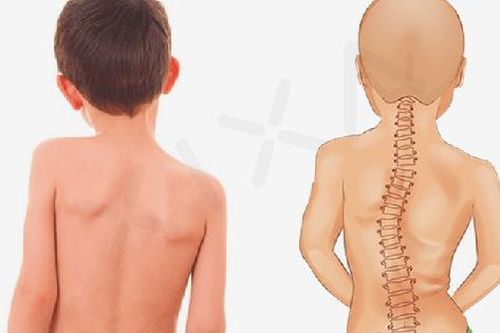 Vẹo cột sống ở trẻ nguyên nhân, biểu hiện và các biện pháp phòng ngừa