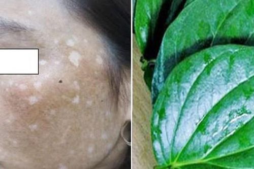 Da loang lổ vì đắp lá trầu không làm trắng da, khắc phục thế nào?