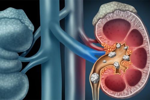 Nhiều bác sĩ cảnh báo nguy cơ bệnh sỏi thận gia tăng, khuyến cáo cách phòng tránh