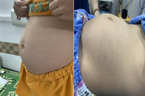 Bé gái 9 tuổi mang khối u nặng hơn 6kg