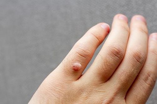 Mụn cóc có 'nhảy' từ người này sang người khác và gây nguy hiểm hay không?