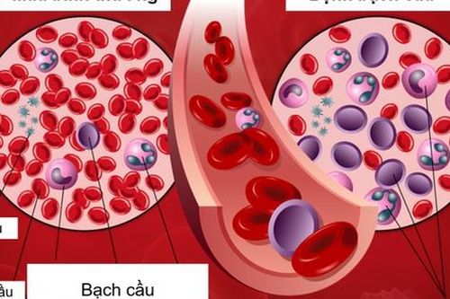 Hy hữu: Tình cờ phát hiện ung thư máu sau khi bị râu tôm chọc vào ngón tay