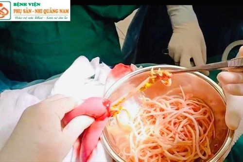 Hơn trăm con giun đũa trong bụng, bé 5 tuổi bị tắc ruột