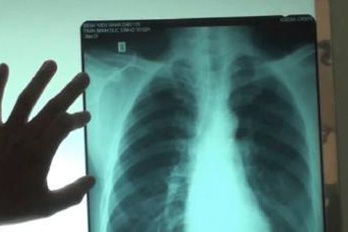 Phát hiện loại ung thư hàng vạn người Việt mắc chỉ bằng phương pháp rẻ tiền