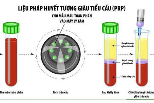 Bệnh viện 30-4 dùng huyết tương giàu tiểu cầu điều trị bệnh