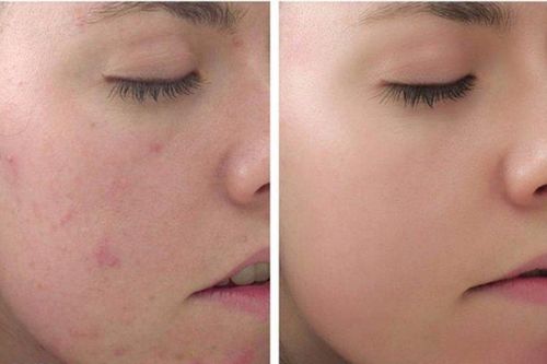 Những điều cần biết về peel da làm trắng