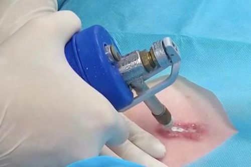 Sự thật về quảng cáo chữa sẹo chỉ một lần duy nhất