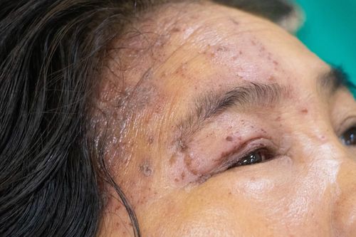 Phải nhập viện khẩn vì biến chứng zona thần kinh