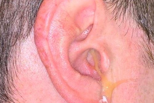 Tự ý dùng thuốc chữa viêm tai giữa, nam thanh niên liệt một bên mặt