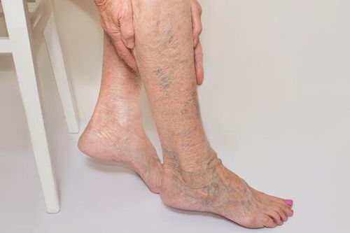 Giãn tĩnh mạch chi dưới