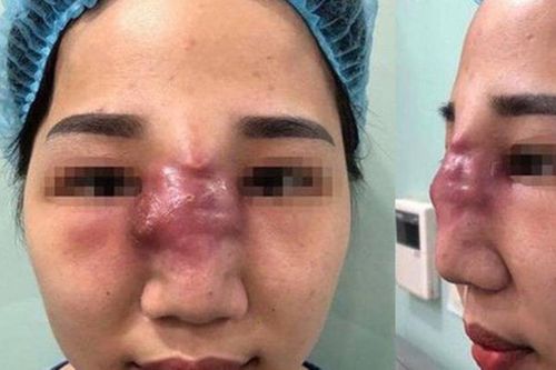 Bác sĩ nêu nguyên nhân biến chứng khi tiêm filler làm đẹp
