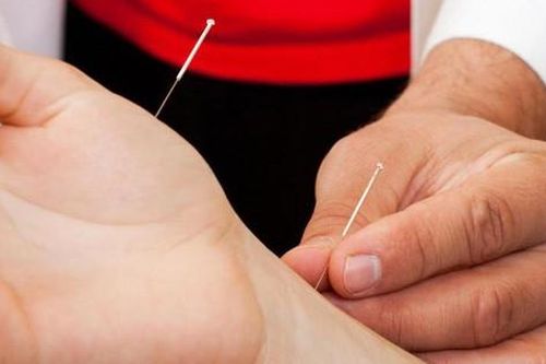 Châm cứu trị viêm khớp dạng thấp cần lưu ý gì?