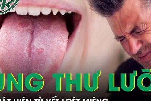 Phát hiện ung thư lưỡi từ vết loét miệng