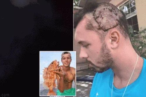 Đi săn răng cá mập rồi bị cá sấu ngoạm vào đầu, chàng trai thoát chết nhờ 2 thứ không ngờ