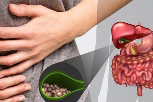 Cắt túi mật có ảnh hưởng đến cuộc sống không?