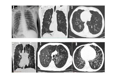 Hội chứng khiến bệnh nhân thường bị viêm đường hô hấp và... đảo ngược phủ tạng