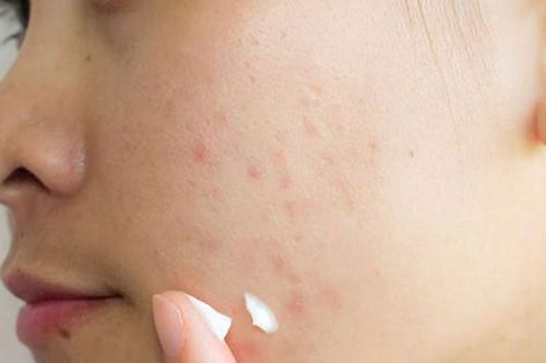Cân nhắc trước quảng cáo điều trị sẹo trên mạng xã hội