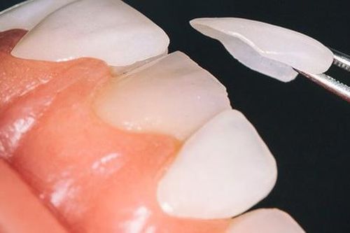 Dị ứng, viêm da toàn thân do dán răng sứ veneer