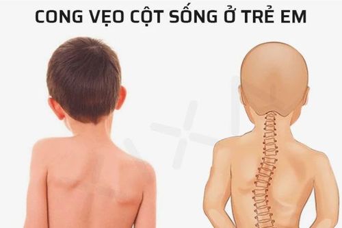 Vẹo cột sống ở trẻ nguyên nhân, biểu hiện và các biện pháp phòng ngừa