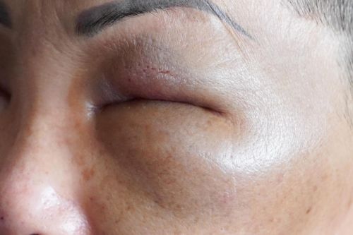 Tây Ninh: Tiêm filler trong nhà nghỉ, hai phụ nữ bị tai biến
