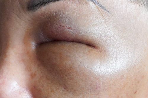 Nửa đêm cấp cứu vì vào nhà nghỉ tiêm filler làm đẹp giá rẻ