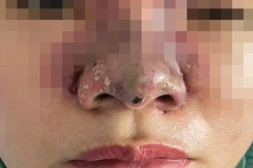 Tiêm filler giá rẻ trong nhà nghỉ, 2 phụ nữ bị tai biến, mất sạch tài sản