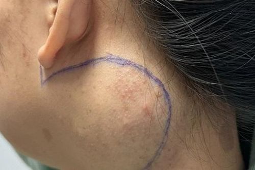 Hạnh phúc vỡ òa với nữ bệnh nhân sau khi phẫu thuật thành công khối u thần kinh ở vị trí nguy hiểm