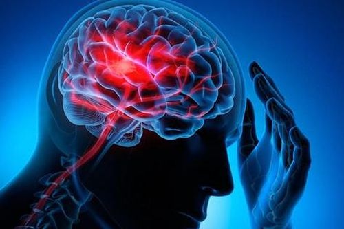 Thầy giáo ở Đồng Tháp qua đời vì đột quỵ: Nguyên nhân, dấu hiệu nhận biết đột quỵ