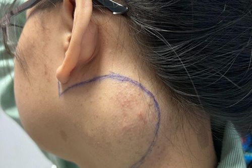 Cô gái 18 tuổi 'sống chung' với khối u lớn ở cổ suốt 7 năm