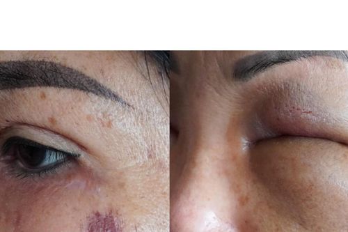 Tiêm filler giá rẻ tại nhà nghỉ, người phụ nữ vừa bị tai biến vừa mất sạch tài sản