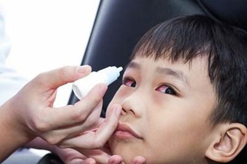 Đã xác định được tác nhân gây bệnh đau mắt đỏ ở TP HCM