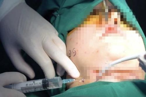 Truy tìm 'Thủy thẩm mỹ' tiêm filler rồi chiếm đoạt tài sản