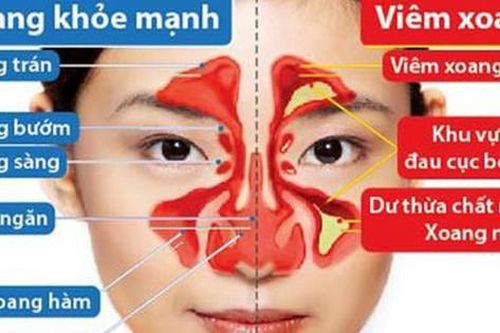 Bài thuốc 'Khương hoạt xung hòa thang' chữa viêm xoang mũi