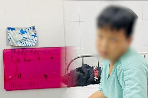 Gắp thành công viên thuốc nguyên vỏ trong thực quản bệnh nhi 10 tuổi