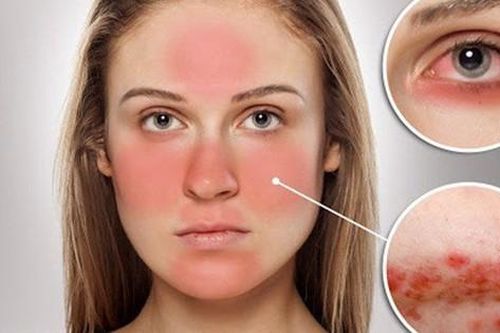 Thuốc trị viêm da tiết bã
