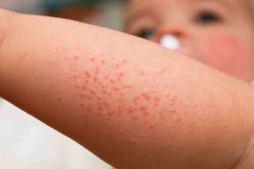 Nhiễm trùng huyết - cách nhận biết và can thiệp sớm để bảo toàn tính mạng