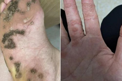 Hà Nội: Cả nhà nổi chi chít 'hạt cơm' ở chân vì... đi chung dép
