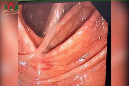 Thích ăn gỏi cá, rau sống người phụ nữ đi khám sức khỏe phát hiện ký sinh trùng trong đại tràng
