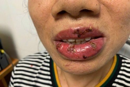 Môi chạm vào là chảy máu sau khi xăm tại cơ sở thẩm mỹ