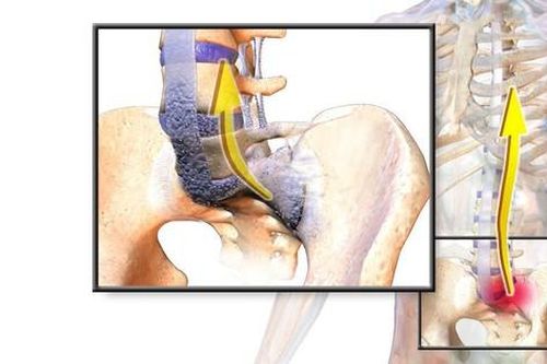 5 biện pháp giảm triệu chứng viêm cột sống dính khớp