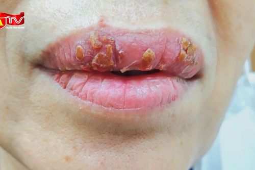 Xăm môi làm đẹp bị viêm da nhiễm trùng nặng