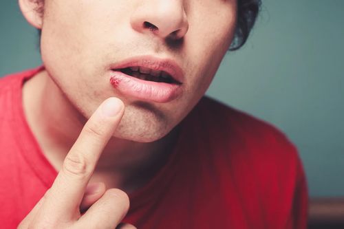 Ức chế sự lây lan của virus herpes