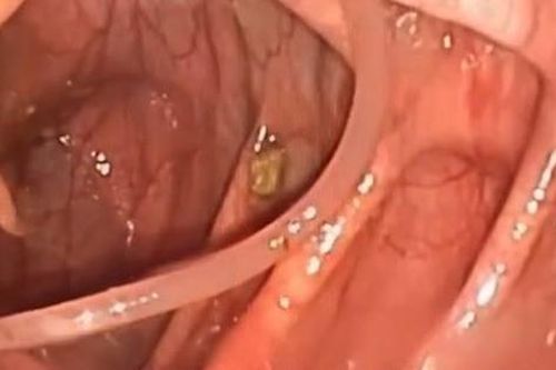 Giun đũa 10cm sống trong lòng đại tràng, cách giúp phát hiện sớm