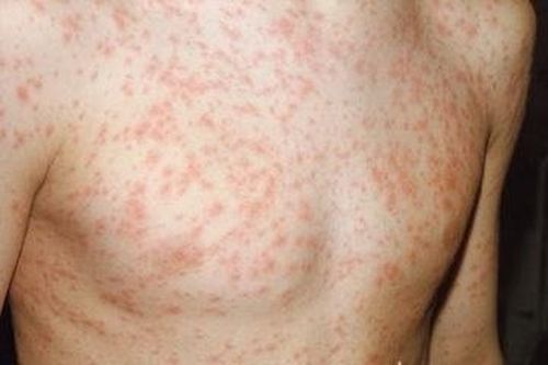 Nguy cơ nhiễm trùng huyết ở trẻ em