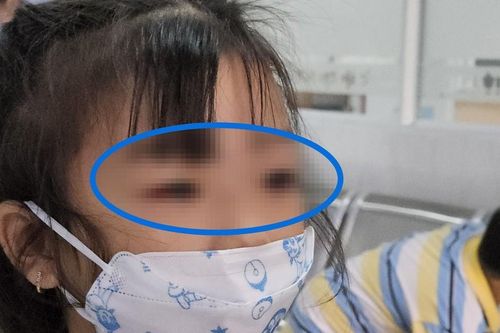 Virus gây bùng phát bệnh đau mắt đỏ tại TPHCM từng xuất hiện ở nhiều đại dịch trên thế giới